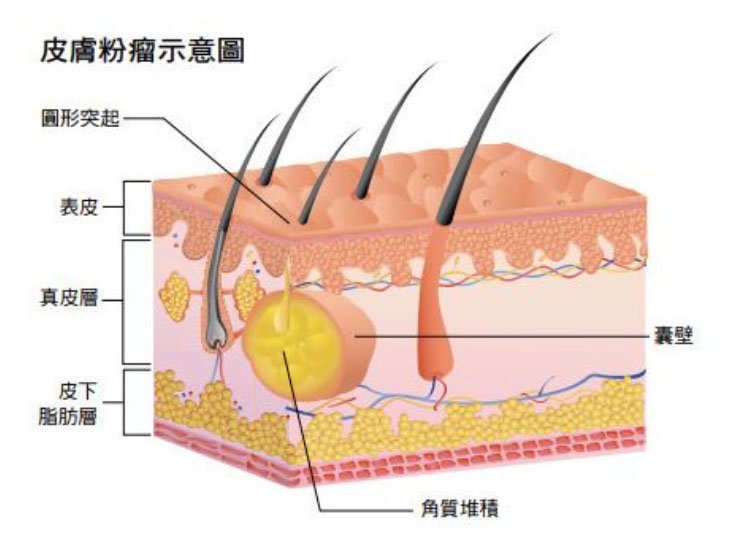 粉瘤